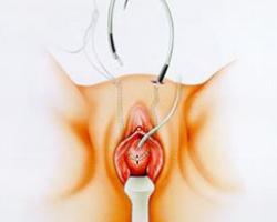 ostetriciaeginecologia it trattamento-incontinenza-urinaria 012