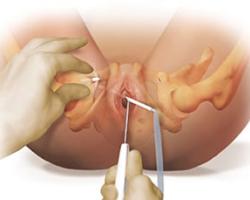 ostetriciaeginecologia it trattamento-incontinenza-urinaria 014