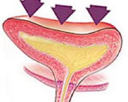 ostetriciaeginecologia it trattamento-incontinenza-urinaria 003