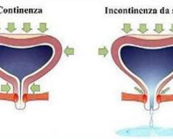 ostetriciaeginecologia en treatment-of-stress-urinary-incontinence 004