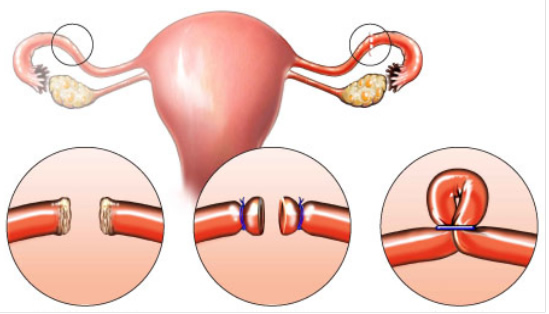 pomeroy women Approximately two-thirds of women with a pomeroy tubal ligation become pregnant following tubal ligation reversal tubal ligation procedures. pomeroy women Approximately two-thirds of women with a pomeroy tubal ligation become pregnant following tubal ligation reversal tubal ligation procedures.