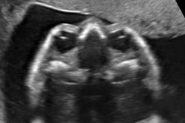 ostetriciaeginecologia en osbtectrical-ultrasound 003