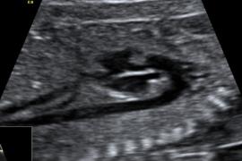 ostetriciaeginecologia en osbtectrical-ultrasound 007