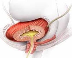 ostetriciaeginecologia en treatment-of-stress-urinary-incontinence 009