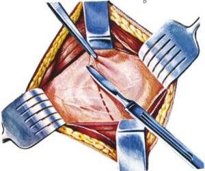 ostetriciaeginecologia it chirurgia-ginecologia-colpo-laparotomica 003