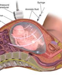 ostetriciaeginecologia it nipt-test-prenatale-non-invasivo 004