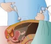 18-19.09.2014 CORSO RESIDENZIALE DI CHIRURGIA LAPAROSCOPICA GINECOLOGICA