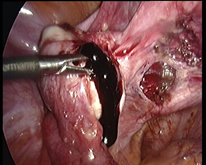 ostetriciaeginecologia en gynecological-laparoscopy 001