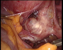 ostetriciaeginecologia en gynecological-laparoscopy 003