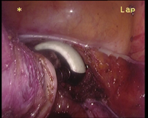 ostetriciaeginecologia en gynecological-laparoscopy 004