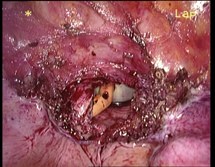 ostetriciaeginecologia en gynecological-laparoscopy 005