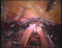 ostetriciaeginecologia en gynecological-laparoscopy 006